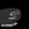 SPORK, NICO - 22.03.1976 - 02.08.2022 - CT obere Extremität - 18:02:23
